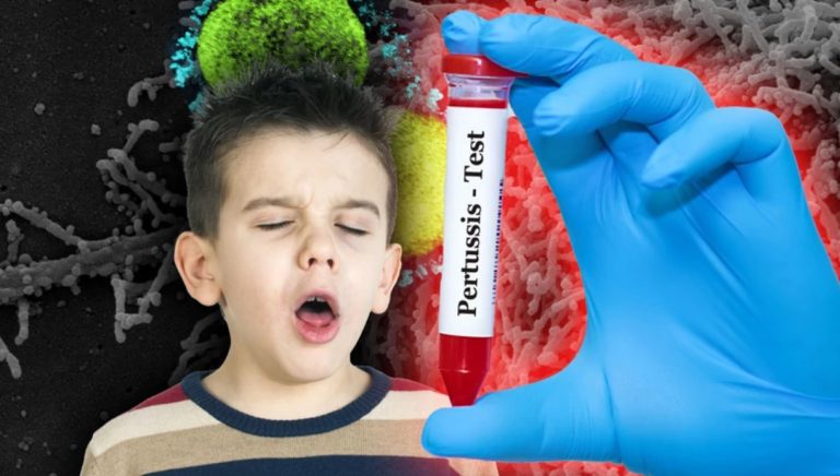 Нови 27 случаи на голема кашлица, најмногу во Скопје